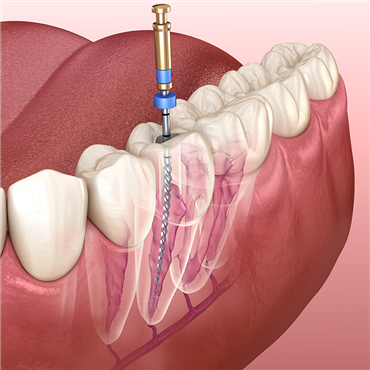 Endodonti (Kanal Tedavisi)